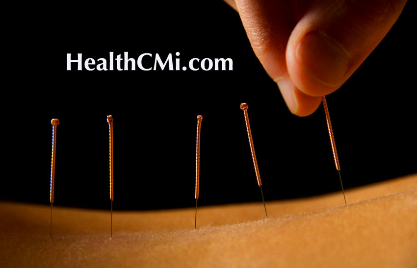 Acupuncture Herpes Shingles Pain Relief